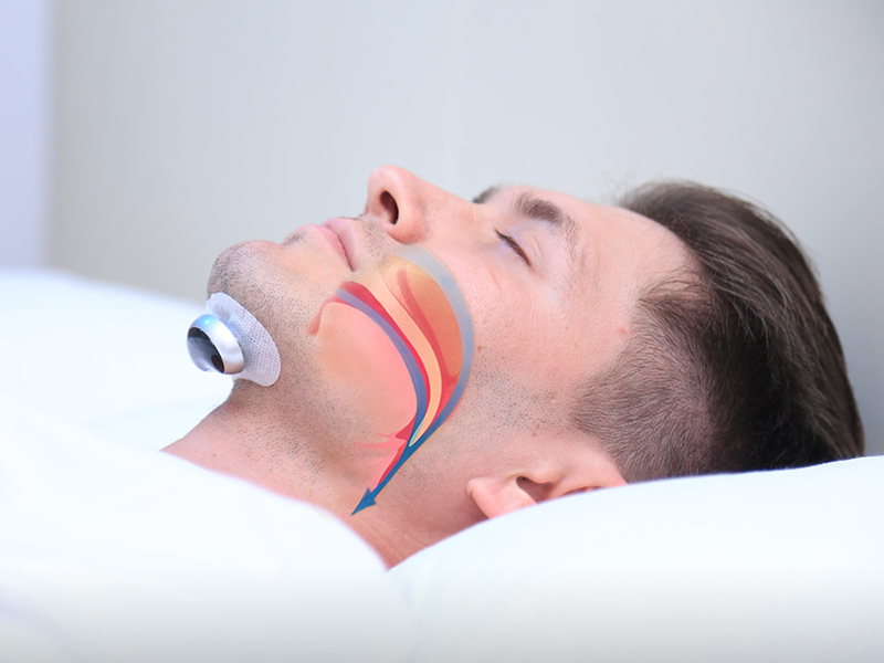 Dispositivo Antisnoring Confortevole – QuietWave